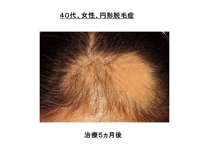 円形脱毛症　病院